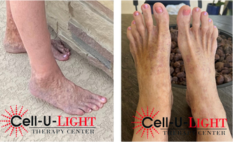 Photos of patients feet before and after hot and cold plunge therapy