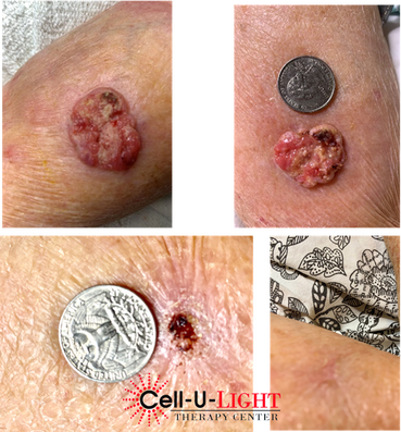 Before and After Pictures of Laser Therapy Patient