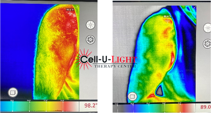 Before and After Pictures of Laser Therapy Patient
