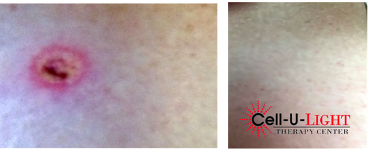 Before and After Pictures of Laser Therapy Patient