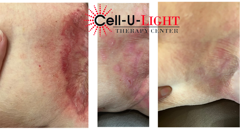 Before and After Pictures of Laser Therapy Patient