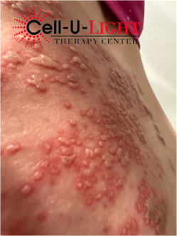 Before Picture of Patient with Shingles