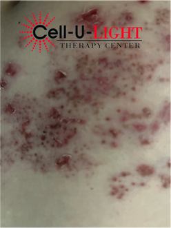 After Picture of Patient with Shingles who received Laser Therapy